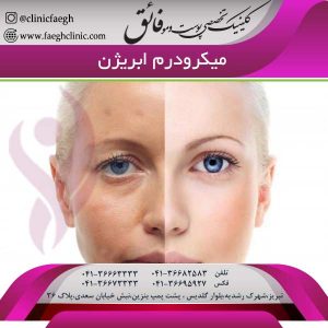 میکرودرم ابریژن