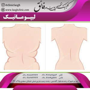 لیپوماتیک