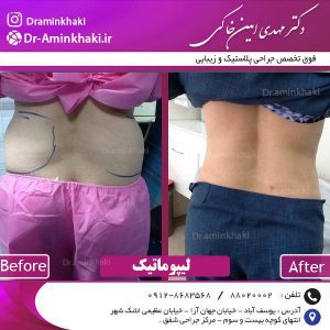 مراقبتهای بعد از لیپوماتیک