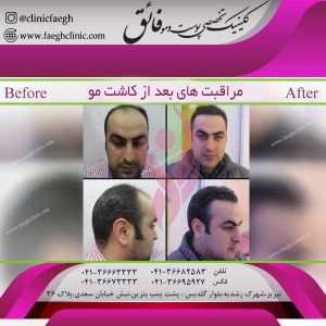 مراقبت های بعد از کاشت مو 