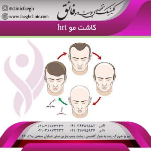کاشت مو hrt 