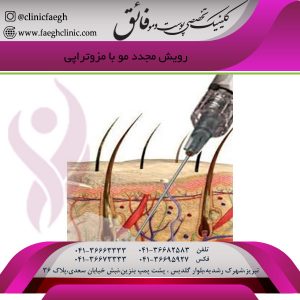 رویش مجدد مو با مزوتراپی