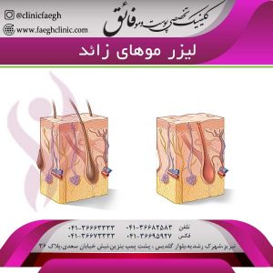 لیزر موهای زائد