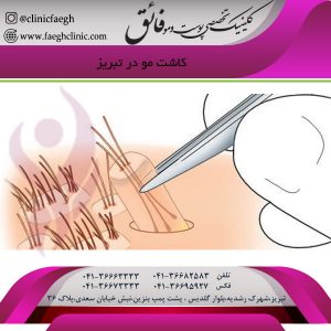 کاشت مو در تبریز